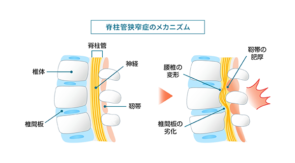 脊柱管狭窄症のメカニズム