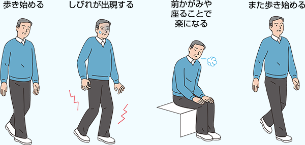 歩き始める しびれが出現する 前かがみや座ることで楽になる また歩き始める